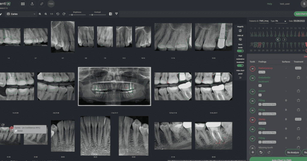 Denti AI Detect & Auto-Chart